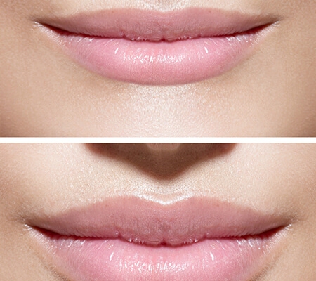 Beispiel Agenturbild / Vorher - Nachher Lippe