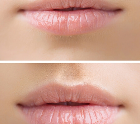 Beispiel Agenturbild / Vorher - Nachher Lippe