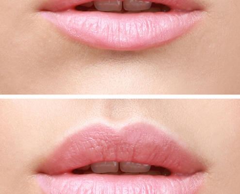 Beispiel Agenturbild / Vorher - Nachher Lippe