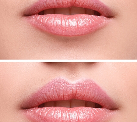 Beispiel Agenturbild / Vorher - Nachher Lippe
