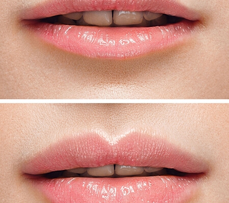 Beispiel Agenturbild / Vorher - Nachher Lippe