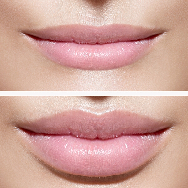 Lip Fillers für ein jüngeres Aussehen. Lippenkorrektur in Linz mit Hyaluronsäure Lip Filler. Lippen Vergrößerung, Lippen Volumen und Lippenkontur.