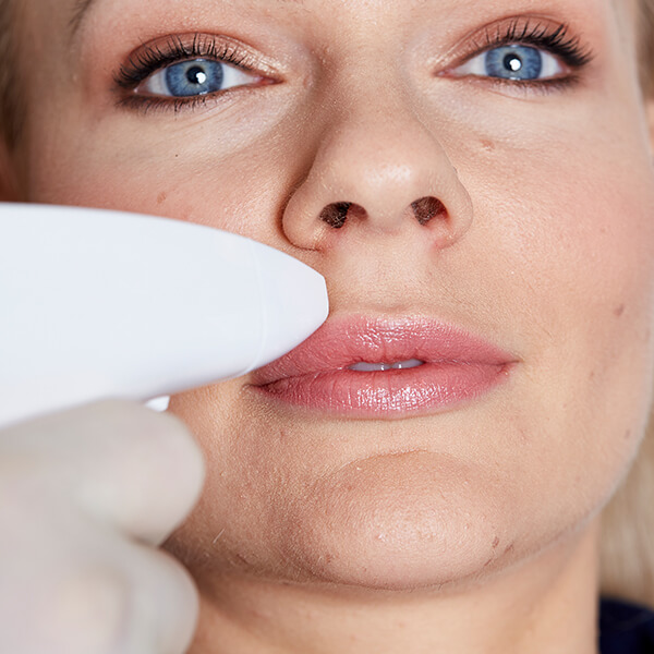 Lippenfalten Lasern Linz Effektiv Und Dauerhaft Lippenfalten Entfernen