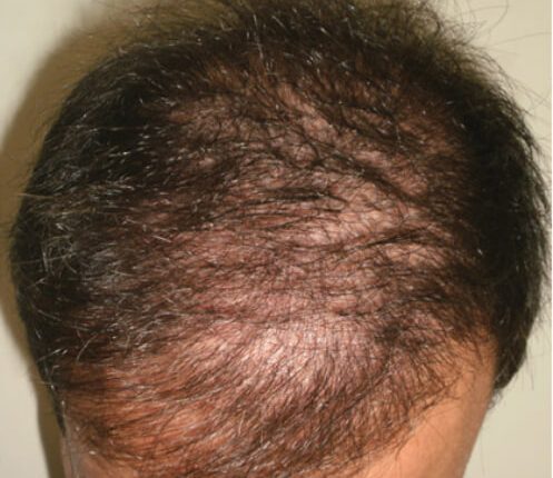 prp behandlung haare linz prp bei